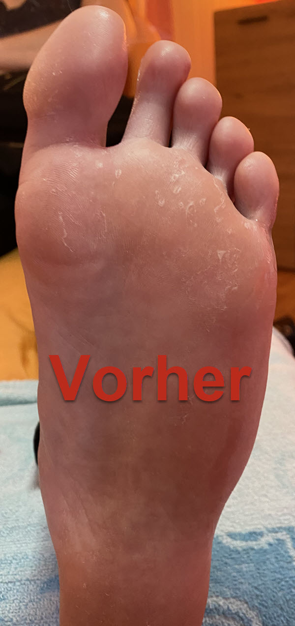 Fusssohle links vorher