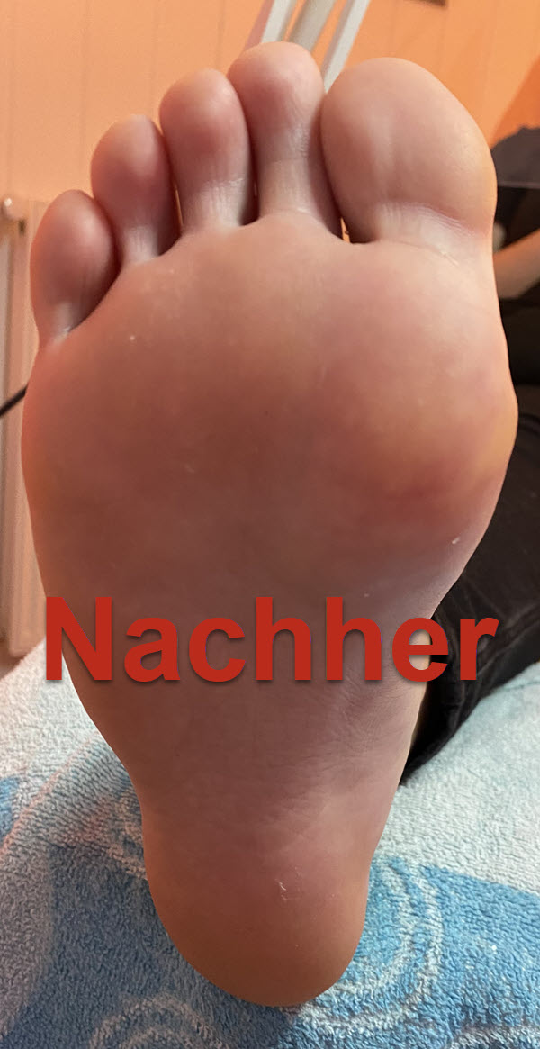 Fusssohle rechts nachher Fusssohle rechts nachher