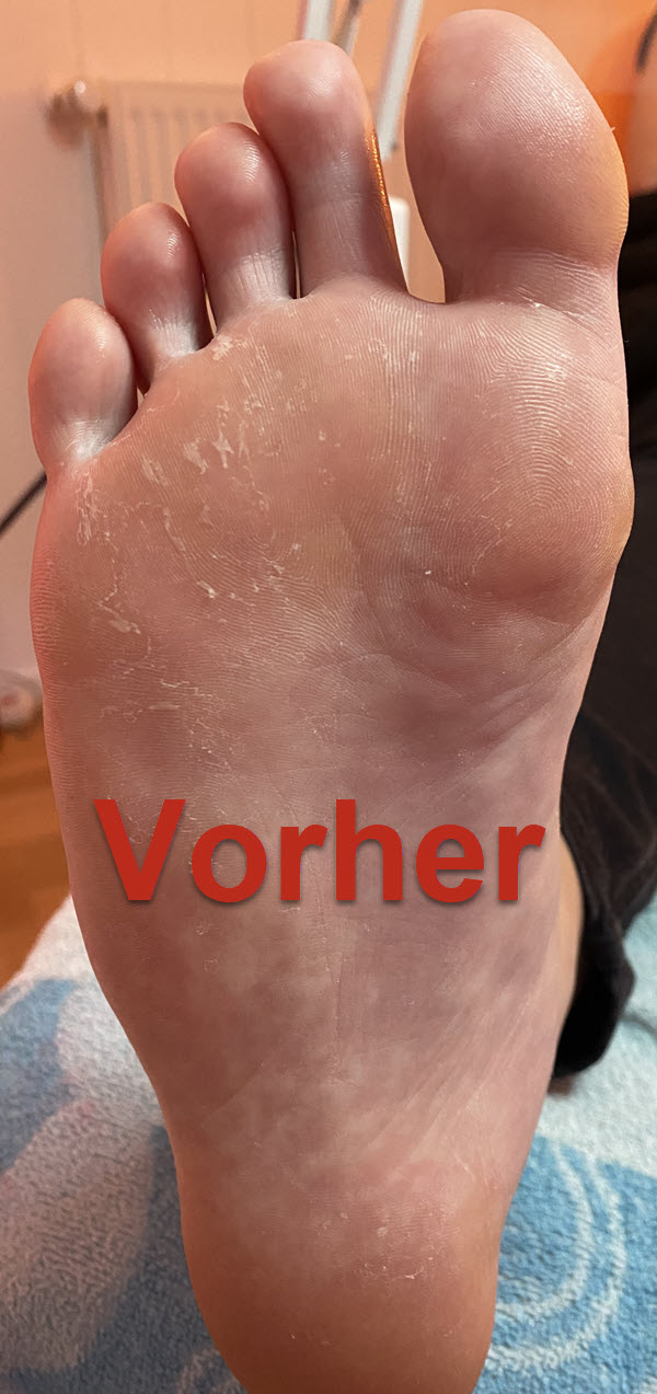 Fusssohle rechts vorher