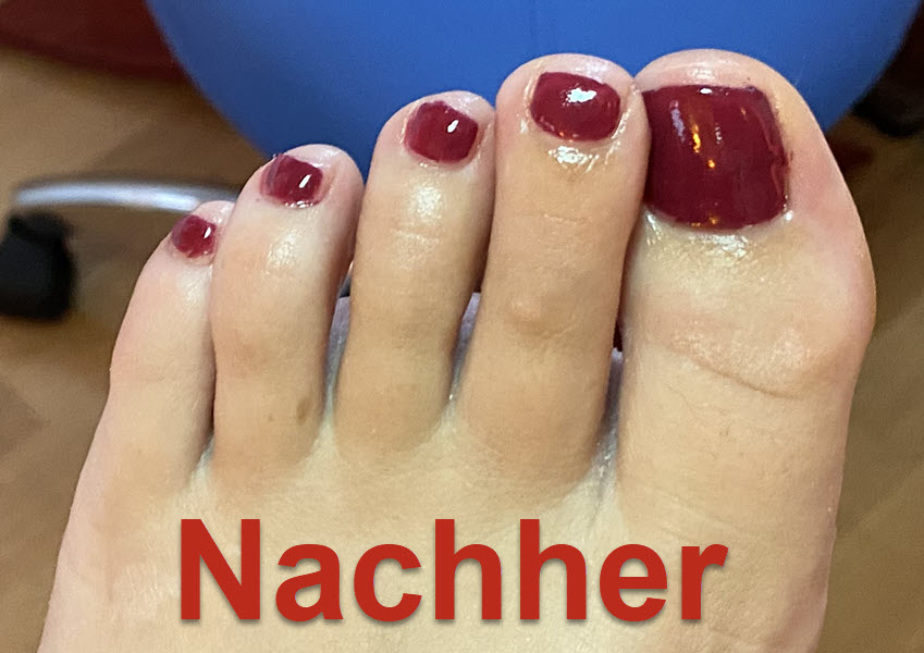 Zehennagel links nachher Zehennagel links nachher