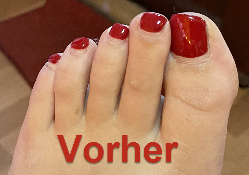 Zehennagel links vorher