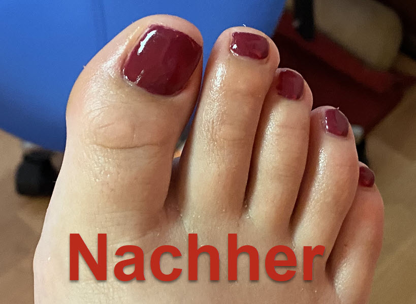 Zehennagel rechts nachher Zehennagel rechts nachher