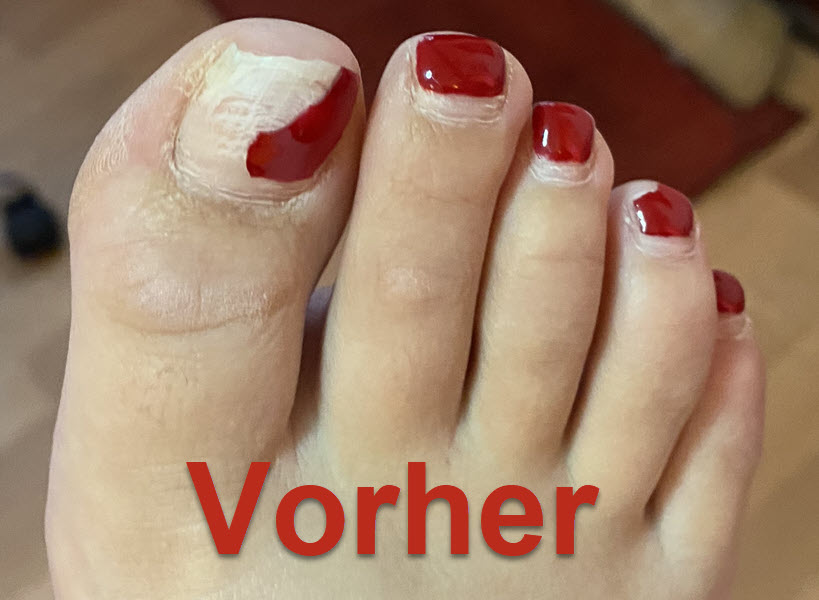 Zehennagel rechts vorher